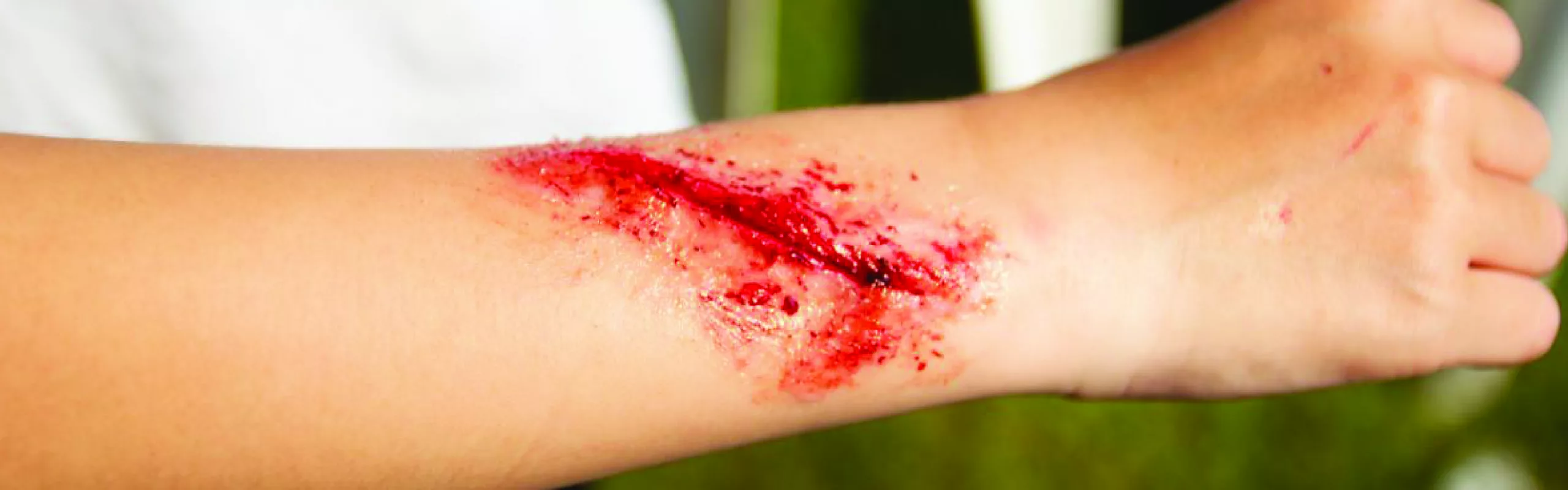 First Aid Tips for Wound Care When Injured